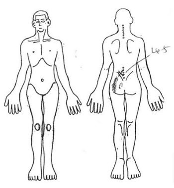 左L4/5の叩打痛および殿部の痛み・重みを認める